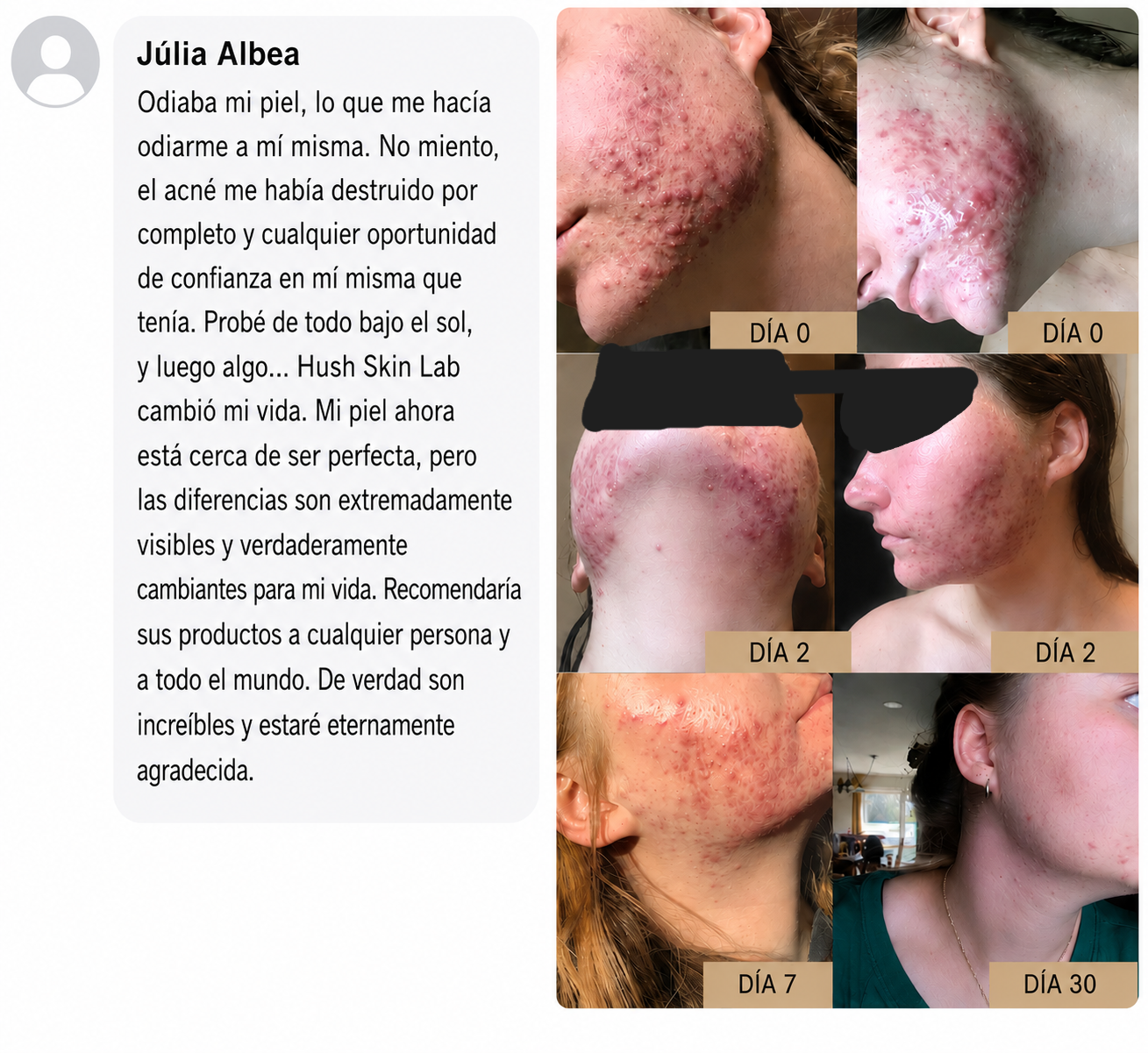 El Acné Severo Mejora Noche a Noche