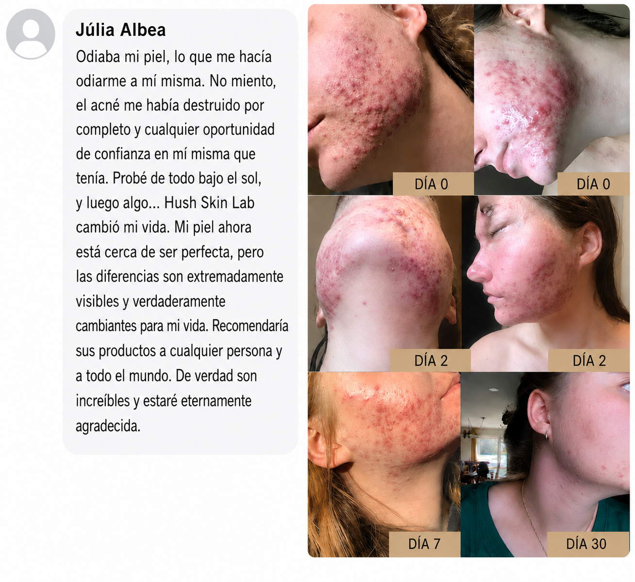 El Acné Severo Se Soluciona En Semanas